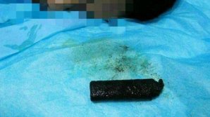 NO COMMENT: O brichetă înghiţită în urmă cu 20 de ani a fost scoasă din stomacul unui chinez