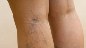 Cum scapi rapid de varice! Cel mai eficient tratament naturist