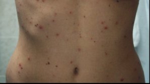 Bine de știut! Ce se întâmplă dacă ieşi afară când ai varicele