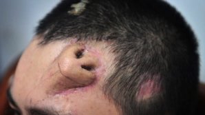 Cazul care a speriat o lume întreagă! Unui bărbat i-a crescut un nas pe frunte (FOTO)