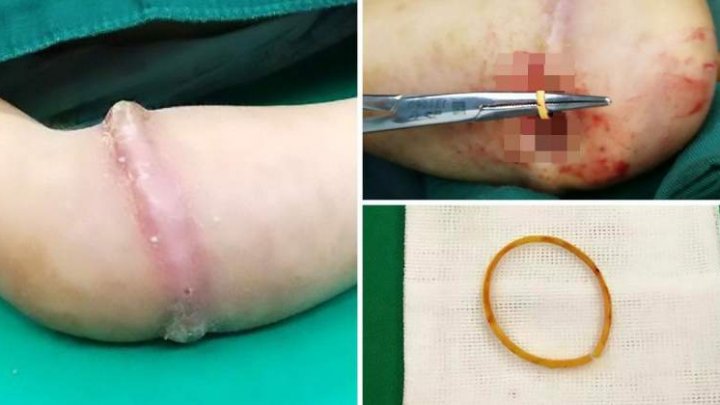 Groaznic: Ce a pățit o fetiță după ce a ținut prea mult timp un elastic pe braț (IMAGINI CU IMPACT EMOȚIONAL)