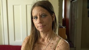 Transformarea spectaculoasă! O femeie și-a extirpat peste 6.000 de tumori de pe corp. Cum arată acum 