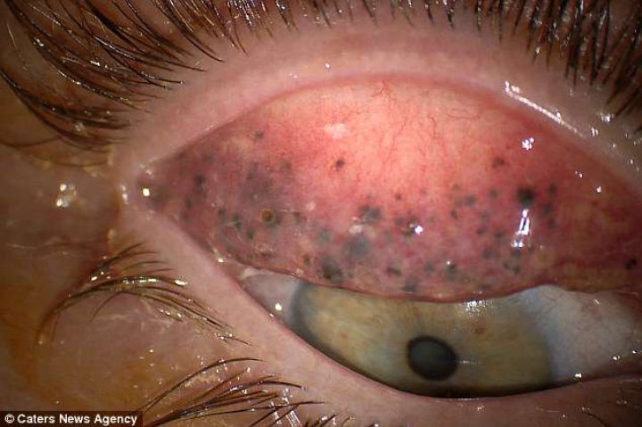 AVERTISMENT! Ce a pățit o femeie care obișnuia să folosească rimel. Imagini șocante