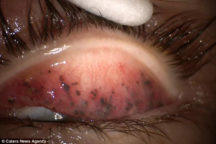 AVERTISMENT! Ce a pățit o femeie care obișnuia să folosească rimel. Imagini șocante