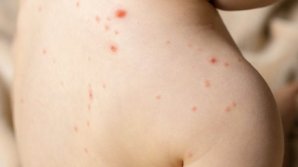 46 de cazuri de rujeolă au fost confirmate, iar 10 persoane încă aşteaptă rezultatele analizelor