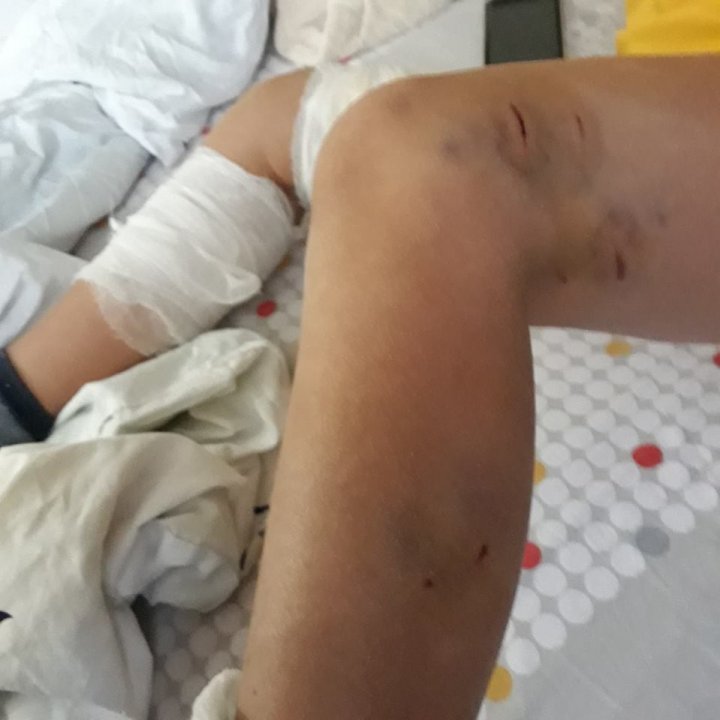 Atacul câinilor fără stăpân: Un copil din Drochia a ajuns la spital, după ce a fost atacat de o haită de maidanezi, chiar în curtea şcolii (GALERIE FOTO)