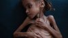 Fetiţa de 7 ani care a devenit simbolul crizei umanitare din Yemen a murit