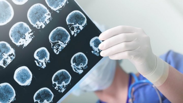 Semnele care îţi spun că faci accident vascular cerebral. Mergi urgent la spital