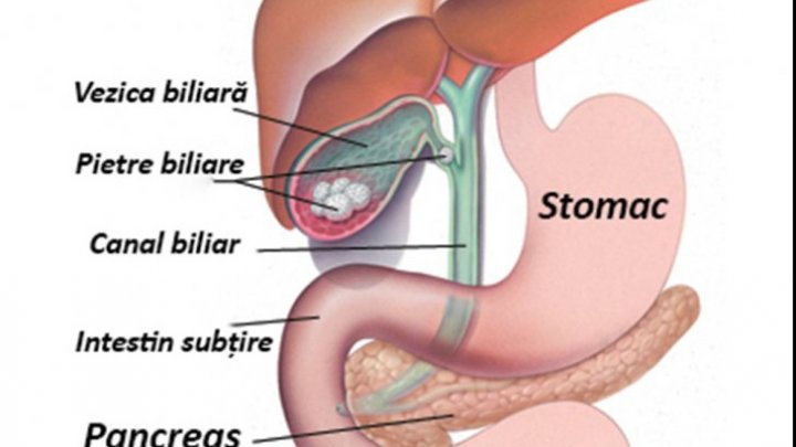 Trebuie să știi asta! Cancerul vezicii biliare: primele simptome