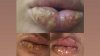 POVESTEA ŞOCANTĂ a unei fete din Capitală care s-a ales cu buzele umflate în urma unei injectări greșite cu biopolimer (VIDEO)