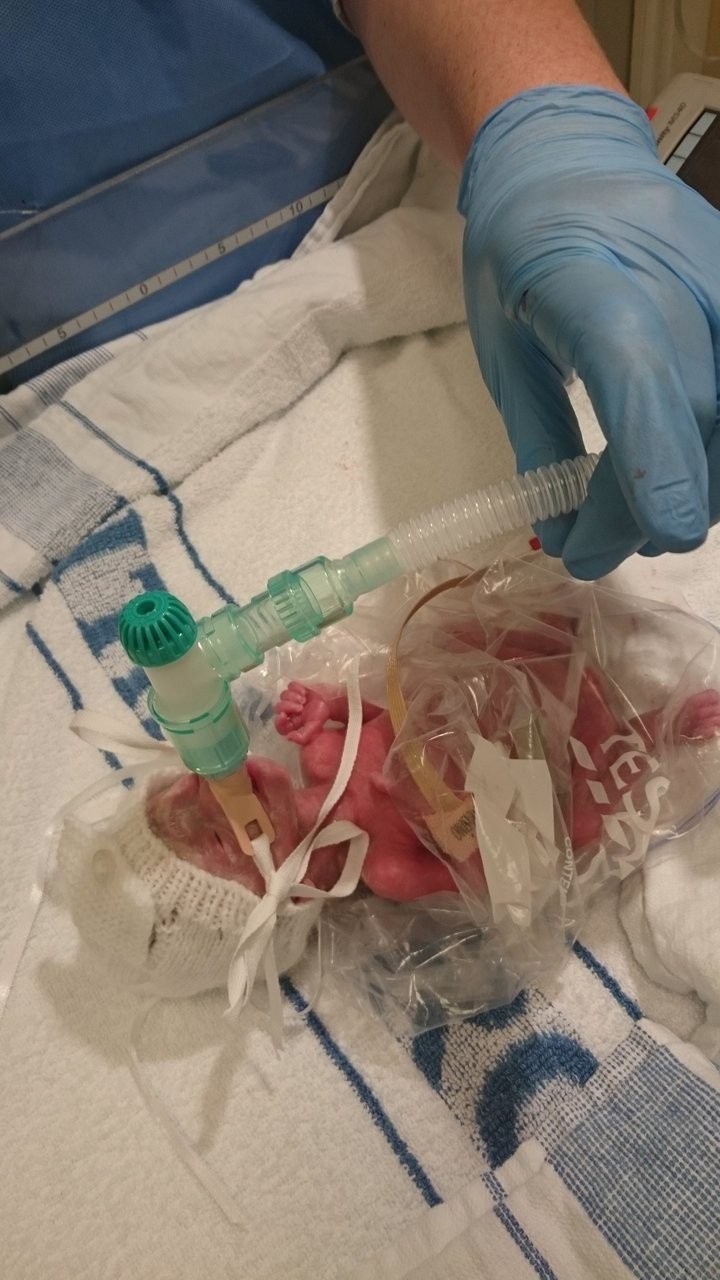 Povestea emoţionantă a unei fetiţe născută prematur, de numai 500 de grame şi salvată de medic cu ajutorul unei pungi de sandviş (FOTO)