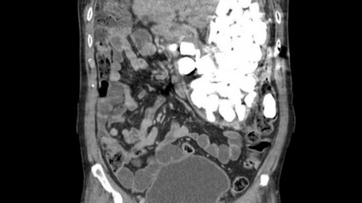 Medicii AU RĂMAS ŞOCAŢI. Ce au descoperit în stomacul unui bărbat
