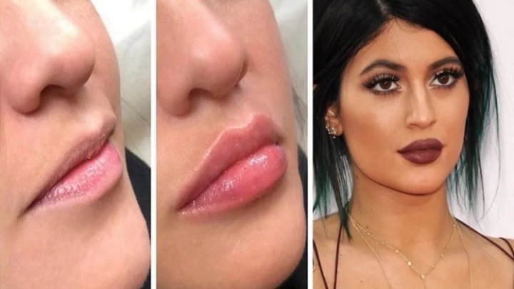 Noua metodă de MĂRIRE A BUZELOR o va înlocui pe cea promovată de Kylie Jenner. Care este INOVAŢIA