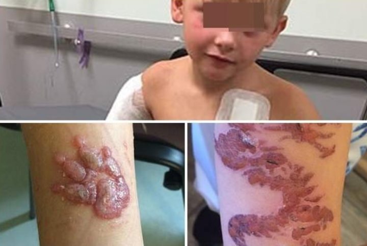 HENNA poate fi PERICULOASĂ. Povestea micuţului care s-a ales cu ARSURI GRAVE după ce şi-a făcut tatuaje temporare (FOTO)