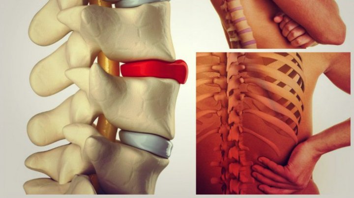 Bine de știut! Ce este hernia de disc? Simptome, cauze și tratament