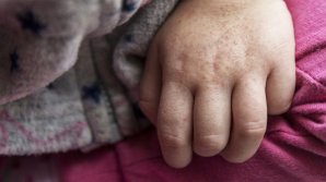 23 de cazuri noi de scarlatină în Capitală