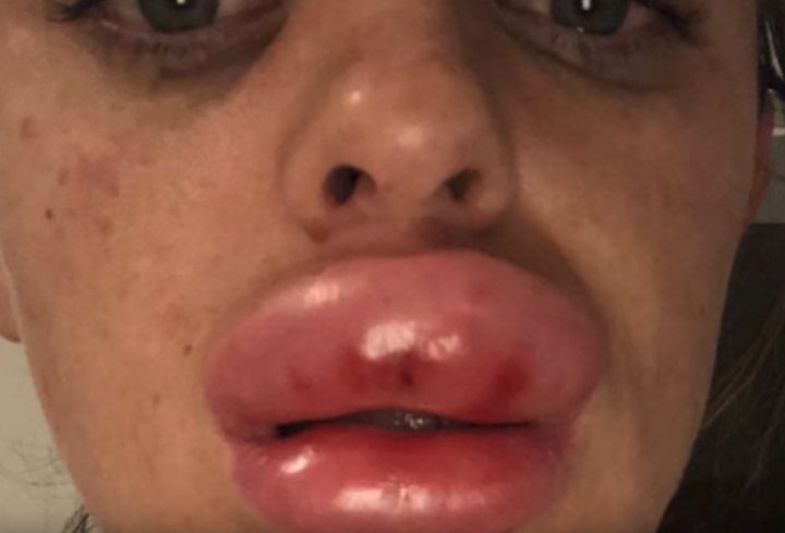 Şocul trăit de o tânără care şi-a INJECTAT BUZELE cu o substanţă suspectă. S-a trezit DESFIGURATĂ