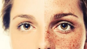 Bine de ştiut! Cum să scapi de pistrui în timp record