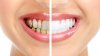 Remedii pentru albirea dinţilor în mod natural. Trucuri cu care nu dai greș