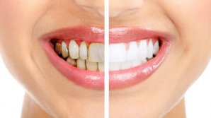 Remedii pentru albirea dinţilor în mod natural. Trucuri cu care nu dai greș