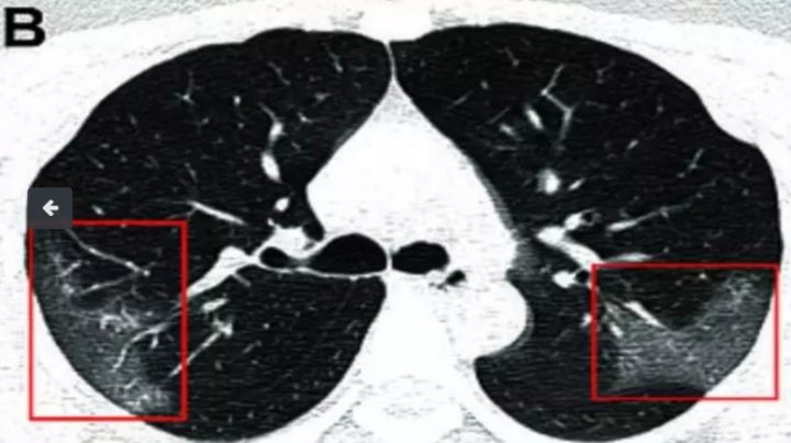 Radiografia care A ŞOCAT lumea medicală. Cum arată plămânii unei persoane infectate cu COVID-19 (FOTO)