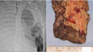 Premieră: O tânără grav afectată de COVID-19 a suferit un dublu transplant de plămâni