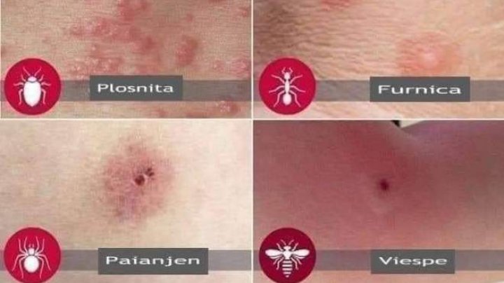 Dicționarul înţepăturilor de insecte. Cum recunoști rănile provocate de căpușe, păianjeni, purici, țânțari sau ploșnițe (FOTO)