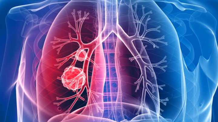 STATISTICI SUMBRE: Cancerul pulmonar a ucis 360 de moldoveni, anul trecut. Principala cauză, fumatul