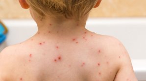 Studiu: Numărul cazurilor de varicelă cu complicații severe s-a dublat din cauza pandemiei