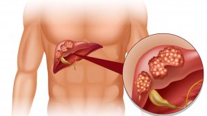 Numărul moldovenilor diagnosticaţi cu cancer hepatic, în scădere. Mai puţini pacienți s-au adresat la medic, pe fundalul pandemiei de COVID