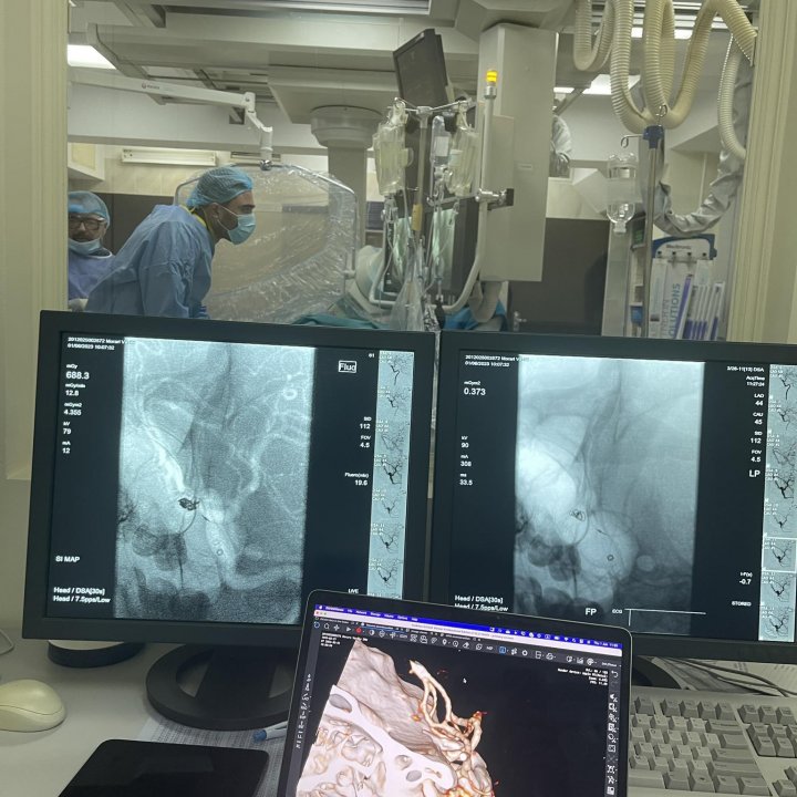 VIDEO/FOTO  Tânăr cu anevrism rupt, salvat printr-o metodă modernă de tratament. Vezi imagini cu operaţia pe creier efectuată de medicii de la IMU