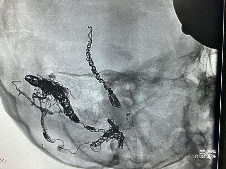 O femeie, salvată cu ajutorul unei proceduri medicale complexe de chirurgii endovasculari de la Spitalul Republican