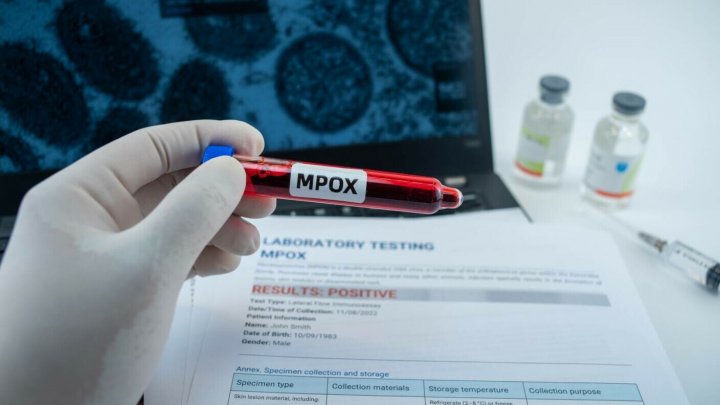 Virusul mpox a ucis 600 de oameni în Congo, majoritatea copii. Simptomele sunt îngrozitoare