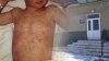 Un copil de 3 ani, din raionul Fălești, diagnosticat cu rujeolă. Micuțul, internat în spital