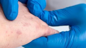 Un nou caz de rujeolă, ÎNREGISTRAT în Republica Moldova. Cine este pacienta