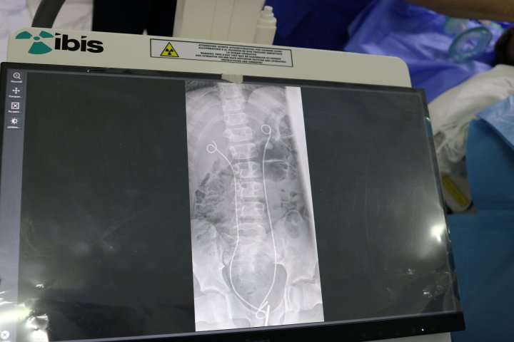 În PREMIERĂ, la Spitalul Clinic Bălți a fost efectuată prima intervenție endoscopică unui copil de 12 ani. IMAGINI din SALA DE OPERAŢIE