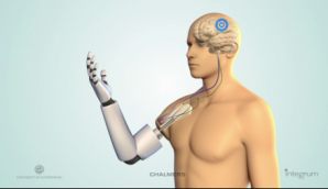 Проведена первая операция по вживлению протеза руки в кость пациента