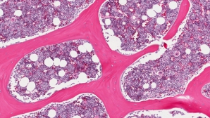 Две американки исцелились от ВИЧ после пересадки костного мозга