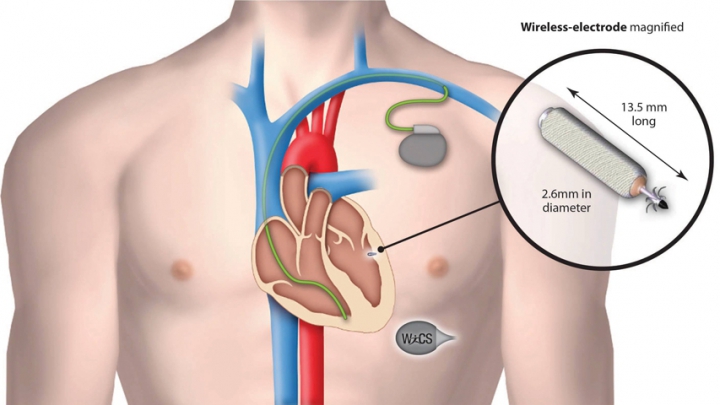 Разработан сердечный имплант размером с рисинку