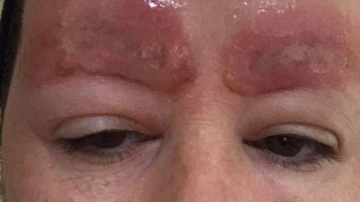 Женщина выложила в Facebook фото татуажа, после которого у неё отвалились брови