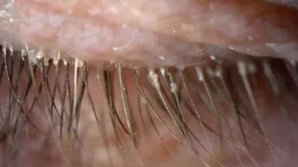 У женщины нашли 100 клещей на ресницах - и всё из-за подушки