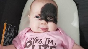 В США родители не хотят удалять родимое пятно дочери и называют ее «супергероем»