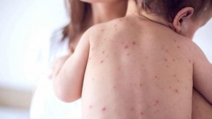 В Чадыр-Лунгском и Глодянском районах подтвердилось три новых случая заболевания корью 