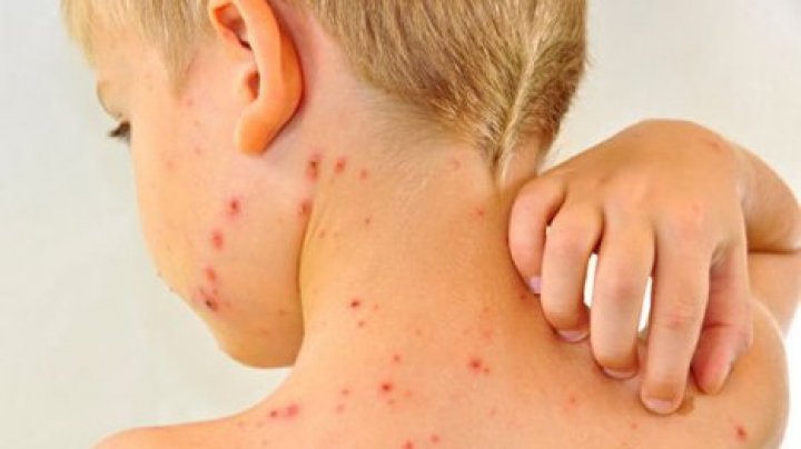 В Одессе от кори умер ребенок