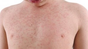 В Молдове зарегистрировали второй случай кори с начала года 