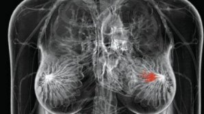 Мобильные кабинеты маммографии помогли обнаружить рак на ранней стадии у 14 женщин