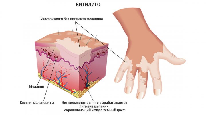 Раскрыта природа загадочной болезни, которой страдал Майкл Джексон