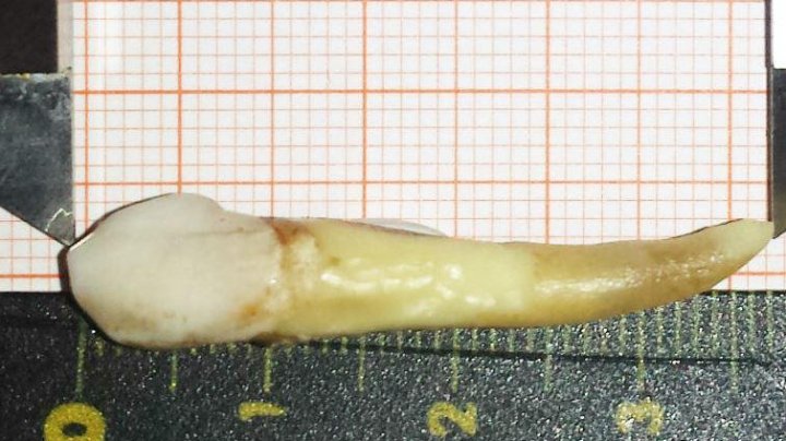 Пациенту удалили самый длинный в истории зуб (ФОТО)