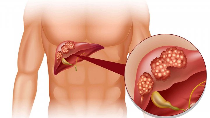 В Молдове в последние годы наблюдается снижение числа смертей от рака печени и желчных протоков